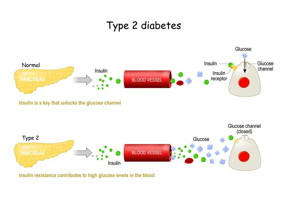 Who Might Benefit Most from Tirzepatide